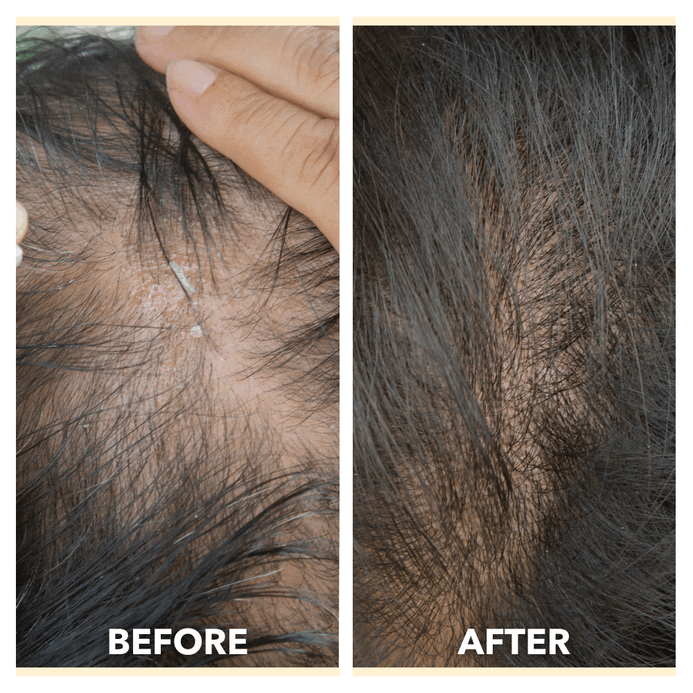 Laser Hair Growth Therapy Pro